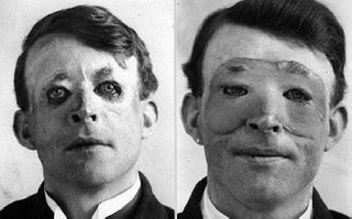 First Skin Transplant 1917