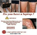 laptop can cause